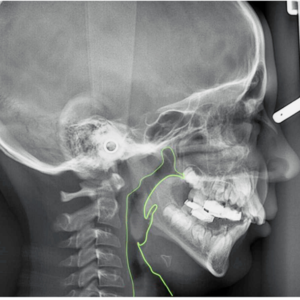 TMD Class II Malocclusion